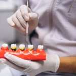 What Are Porcelain Crowns and When Are They Needed?